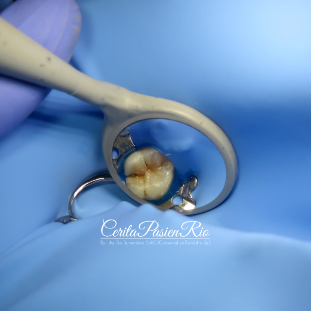 dental loupe 2