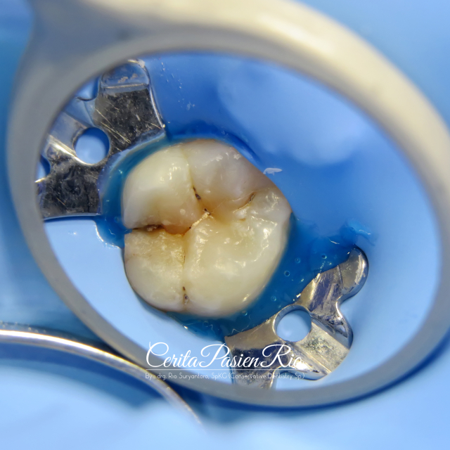dental loupe 3
