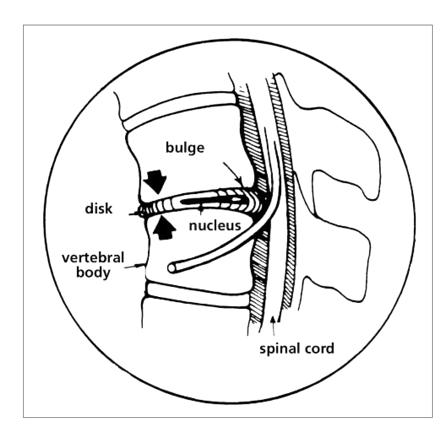 low-back-pain-2