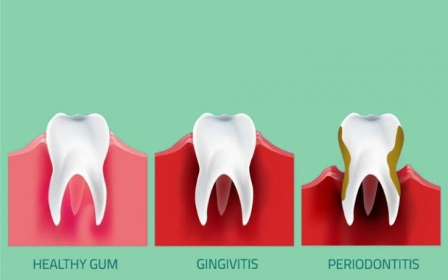 periodontitis