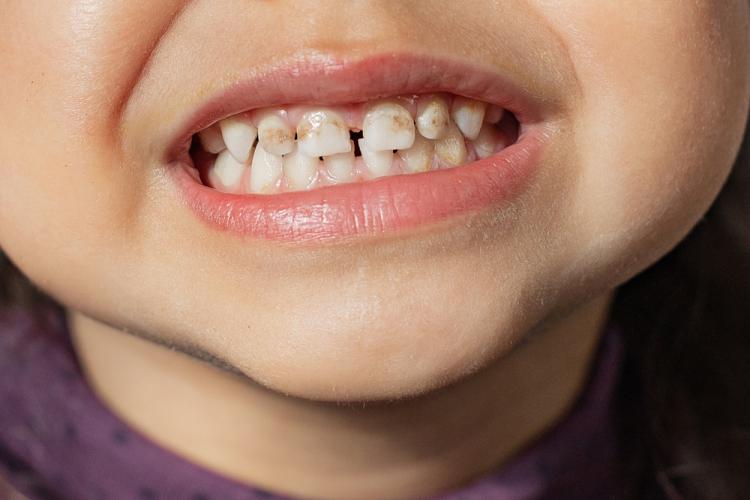 fluorosis pada gigi anak